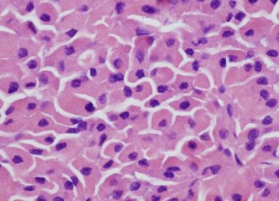 سرطان سلول هرتل چه علائمی دارد و چطور درمان می شود؟